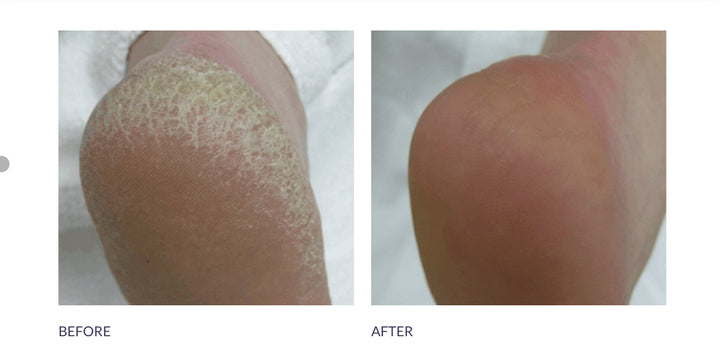 Footlogix Cracked heel formula 125ml - Voor intens herstel van gebarsten hielen