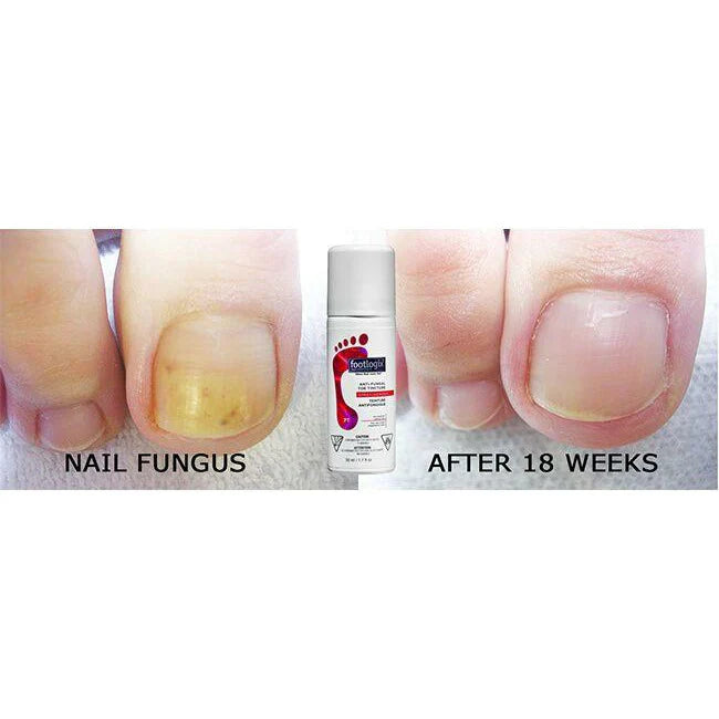 Footlogix Anti schimmel - Toe tincture spray 50ml