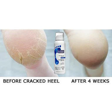 Footlogix Cracked heel formula 125ml - Voor intens herstel van gebarsten hielen