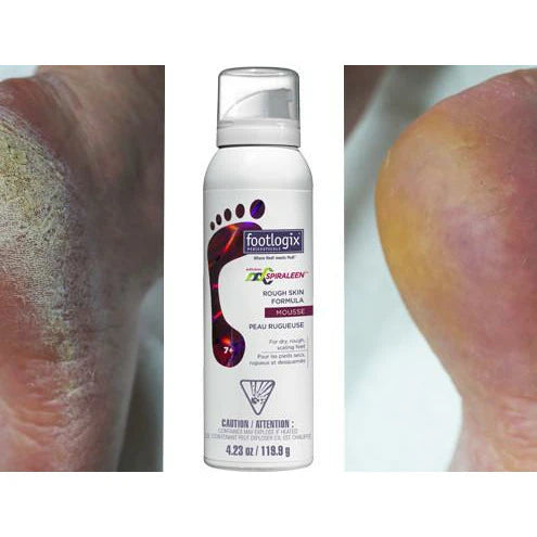 Footlogix Rough skin formula 125ml - Voor droge, ruwe of schilferige huid