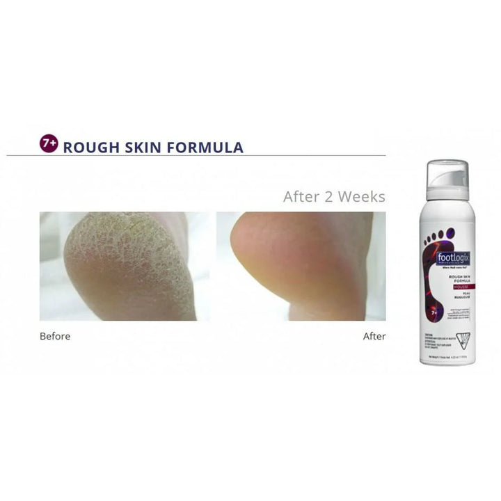 Footlogix Rough skin formula 125ml - Voor droge, ruwe of schilferige huid